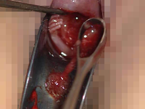 an abortion doctor describes a de 02