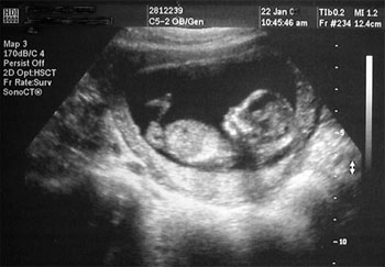 ultra sound 2